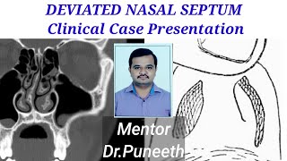 DEVIATED NASAL SEPTUM Clinical Case Presentation [upl. by Hoyt]