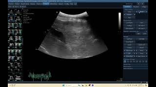 IQ 155 LIVER HEPATOMA ULTRASOUND ECHOPAC ECHOCARDIOGRAPHY HEPATOMA C1 5 RS PROBE [upl. by Neona]