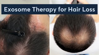 Why Are People Turning to Exosome Therapy for Hair Loss [upl. by Nabru]