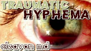 Cleavon MD  Traumatic Hyphema [upl. by Clayson]