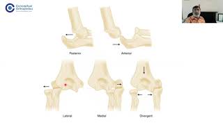 Elbow Instability ConceptualOrthopedics by FRCS Gold Medalists DrRavinder Dimri [upl. by Brod214]