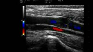 Phlebology Biosound Esaote MyLab 25 Venous Duplex [upl. by Anailuy122]