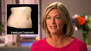 SculpSure Results Testimonials Before amp After Photos [upl. by Eeslehc427]