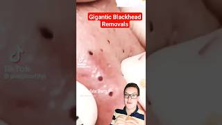 Crazy Satisfying BLACKHEADS REMOVAL  Perfect Blackhead Popping shorts [upl. by Nairam]