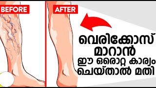 വെരികോസ് മാറാൻ ഈ ഒരൊറ്റ കാര്യം ചെയ്താൽ മതി  Varicose veins Malayalam [upl. by Ellehcsor]