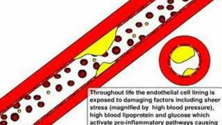 Atherosclerosis and Ischaemic Stroke [upl. by Haden]