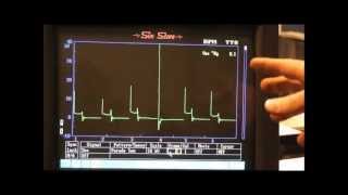 Secondary Ignition Waveforms common faults [upl. by Arotahs286]