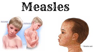 Everything about MEASLES in detail and simple [upl. by Acnaib695]