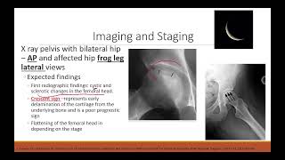 Avascular Necrosis of Femoral Head [upl. by Wanyen]