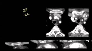 Mediastinal anatomy and nodal stations on CT [upl. by Ehcnalb]