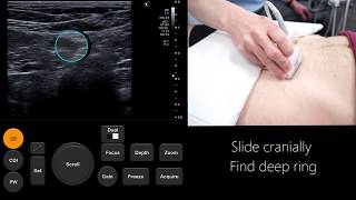 Ultrasound Tutorial InguinalFemoral Hernia Assessment  Radiology Nation [upl. by Fara]