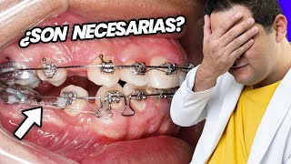 ¡La GUERRA de las EXTRACCIONES de PREMOLARES ¿SACAR DIENTES Es NECESARIO para tu TRATAMIENTO [upl. by Allegra]