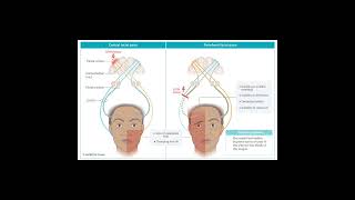 umn vs lmn 7th nerve palsy [upl. by Notnirb875]