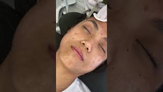 Treat your skin problems with PRP treatment prp [upl. by Alauqahs]