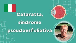 Cataratta sindrome pseudoesfoliativa [upl. by Euphemie]