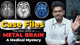 Case Files Ep5  The Man With A Metal Brain  Dr Anuj Pachhel [upl. by Nylekcaj]