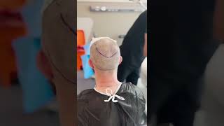 Hairline Restoration  Hair Transplant in Turkey  Longevita [upl. by Travis]