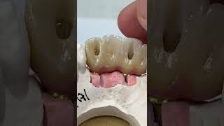 Two implants with 4 unit Hygiene ceramics [upl. by Survance]