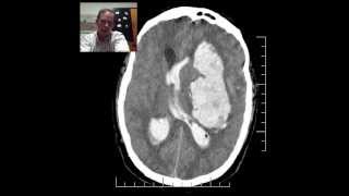 CT Head HTN Hemorrhage w Herniation DISCUSSION by Radiologist [upl. by Asira]