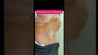 Aneurisma de Aorta Abdominal Examen físico inspección Masa pulsátil Abdominal [upl. by Harat]