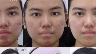 Lutronic Spectra amp Gold Toning Laser Treating Acne amp Redness at BeauampHans Aesthetic [upl. by Googins]