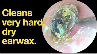 Cleans very hard dry earwax ear wax removal  ear cleaning  ASMR  relaxation  relax [upl. by Arno902]