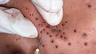 Top of Blackhead Extraction Video 2020  Best Blackhead Removal Videos 2020 [upl. by Rhine]