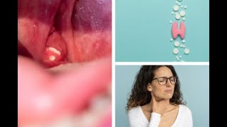 Removing Tonsil Stones At Home [upl. by Andriana]