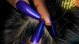 ASMR 1 HR Super Attentive NITPICKING SCALP WHITEHEADS  soft spoken  zoomed [upl. by Rosaline]