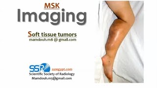 Soft tissue tumors imaging III DRE Prof Mamdouh Mahfouz [upl. by Nomed703]