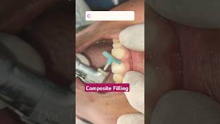 Cosmetic filling in upper front tooth  Composite Filling  Teeth filing composite dentist [upl. by Aikaj]