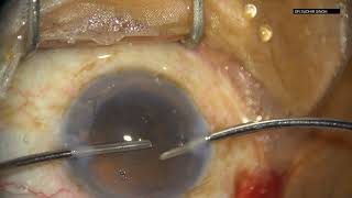 Topical Manual Small Incision Cataract Surgery HD Unedited [upl. by Herzberg]