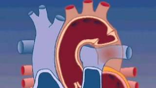 Coarctation of the Aorta [upl. by Lewak]