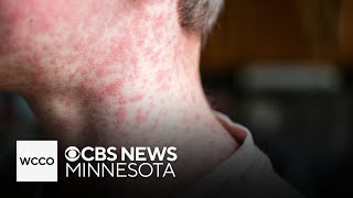 Measles confirmed in Minneapolis school and more headlines [upl. by Hebel778]