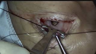 Posterior approach ConjunctivalMullers resection ptosis surgery Putterman procedure [upl. by Baruch524]