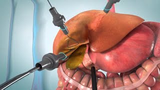 Laparoscopic and open cholecystectomy surgery animation [upl. by Ennoved]