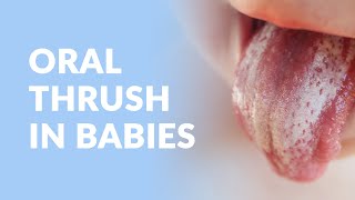 What Is Oral Thrush  AC Pediatric Dentistry amp Orthodontics [upl. by Eceinej]