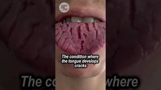 Exploring Fissured Tongue A Painful Condition with Unknown Causes [upl. by Elleinad447]