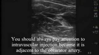 UltrasoundGuided Obturator Nerve Block [upl. by Tabina]