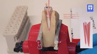 Endodontic treatment of the single rooted tooth Part 6 Obturation [upl. by Elvie]