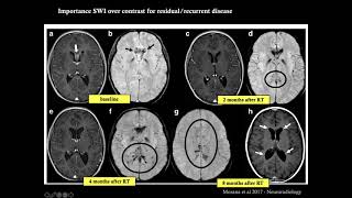 Sellar and Pineal region tumors in children  a guide to Differential diagnosis [upl. by Alys438]