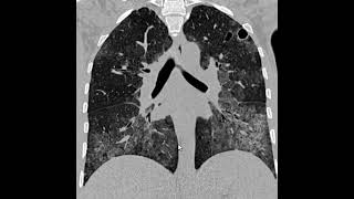 PCP Pneumonia por pneumocystis Jirovecii [upl. by Tychonn44]