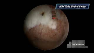 ECTROPION with DIODE LASER HD 720p [upl. by Ober]