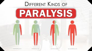 Different Kinds of Paralysis  How Does Someone Become Paralyzed  Types of Paralysis  SRIAAS [upl. by Damal963]