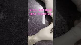 VDRL ANTIGEN TEST POSITIVE medicalcollegestudents youtubeshorts ytshorts lab [upl. by Vikky]