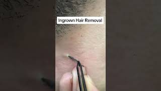 Ingrown hair removal [upl. by Camilo]