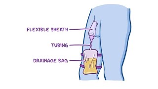 Texas Catheter  Definition Characteristics and Uses [upl. by Brandon]