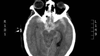 Subarachnoid Hemorrhage CT JETem 2017 [upl. by Eltotsira349]