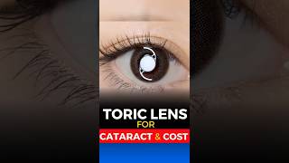 Toric Lens for Cataract Surgery Cost [upl. by Etnauq]