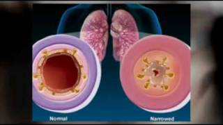 Signs and symptoms of bronchitis Natural herbs treatment of chronic bronchitis [upl. by Eniotna]